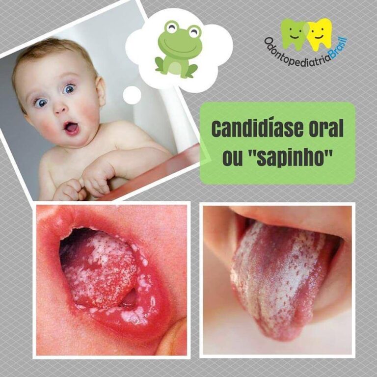 Candidíase Oral – Odontopediatria Brasil
