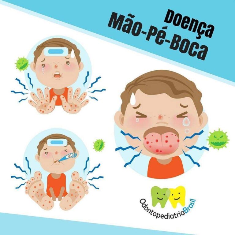 Doença Mão-Pé-Boca – Odontopediatria Brasil