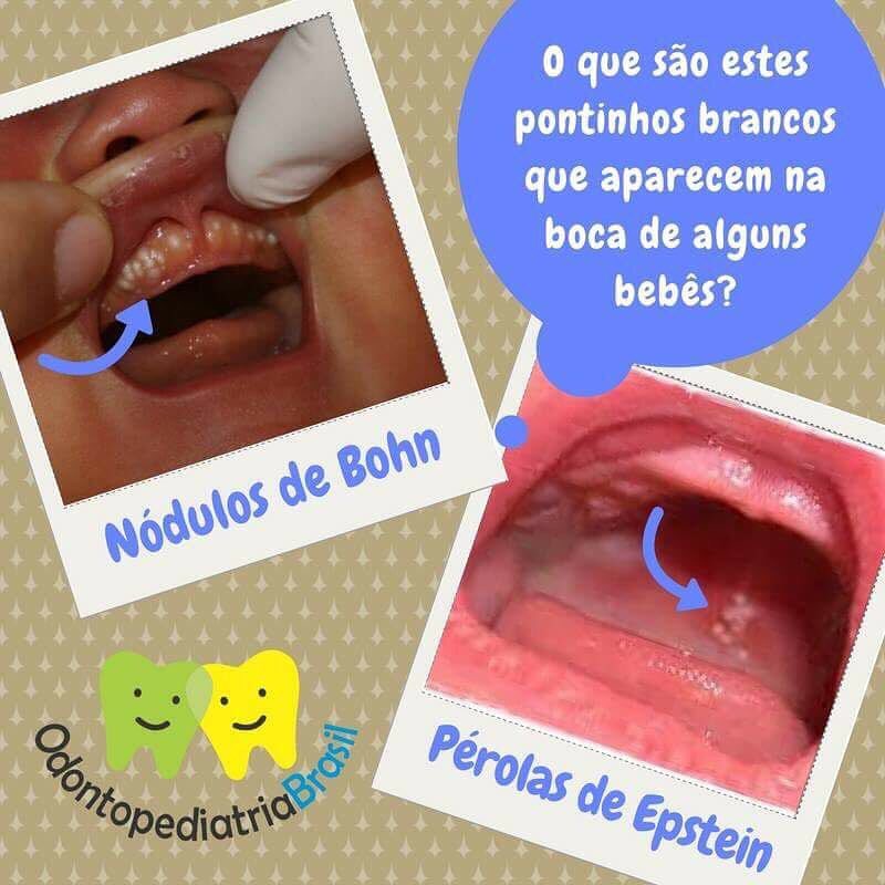 Pérolas de Epstein do recém-nascido: causas, sintomas e tratamento -  Dentalis