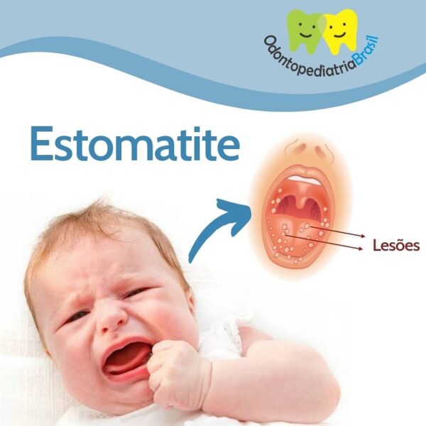 Estomatite Viral – Odontopediatria Brasil