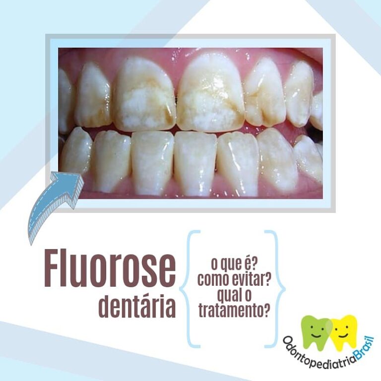 Fluorose Odontopediatria Brasil